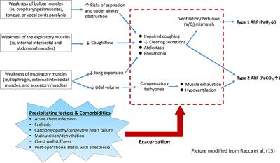 Noninvasive Ventilation and Mechanical Insufflator-Exsufflator for Acute Respiratory Failure in Children With Neuromuscular Disorders